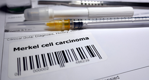 Efficacia e Sicurezza degli Inibitori PD-1/PD-L1 nel Trattamento del Carcinoma a Cellule di Merkel